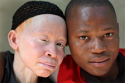 Shutterstock: Unidentified albino mother and son on July 2, 2015 in Ukerewe, Tanzania